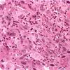 5A2 Gliosarcoma (Case 5) H&E 2