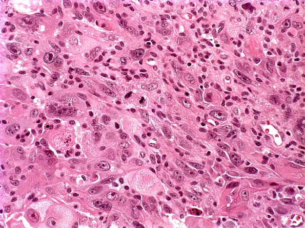 5A2 Gliosarcoma (Case 5) H&E 2