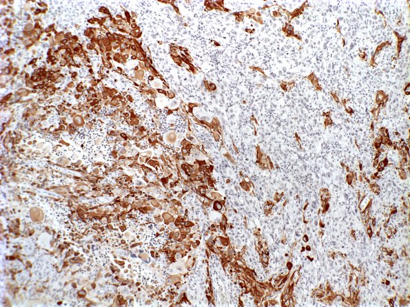 5B Gliosarcoma (Case 5) GFAP a