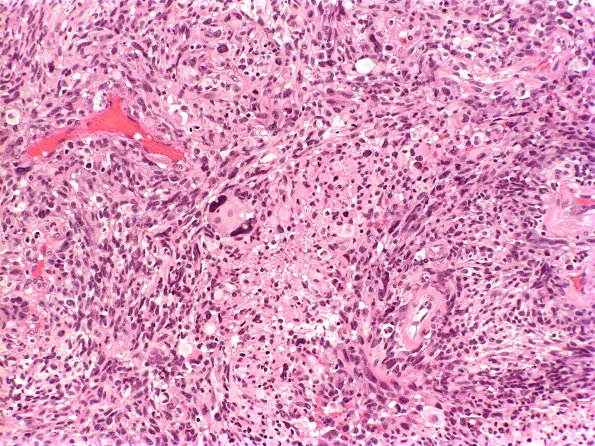 6A1 Gliosarcoma (Case 6) H&E 1