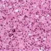 6A2 Gliosarcoma (Case 6) H&E 3