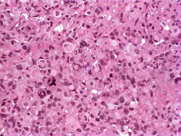 6A2 Gliosarcoma (Case 6) H&E 3