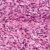 6A3 Gliosarcoma (Case 6) H&E 2