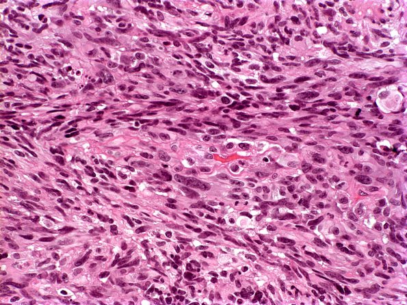 6A3 Gliosarcoma (Case 6) H&E 2