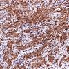 6B Gliosarcoma (Case 6) GFAP 2