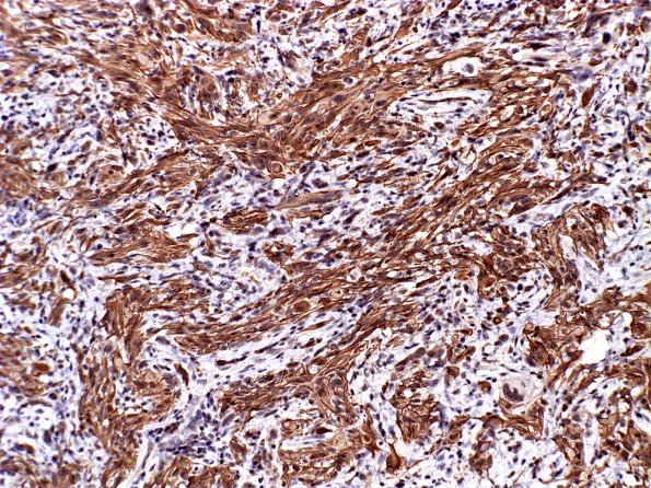 6B Gliosarcoma (Case 6) GFAP 2