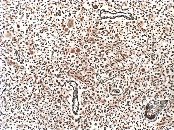 6C1 Gliosarcoma (Case 6) Retic 1