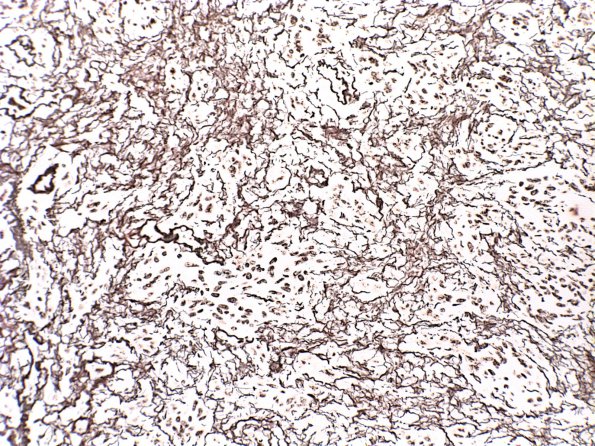 6C2 Gliosarcoma (Case 6) Retic 2