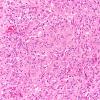 7A2 Gliosarcoma (Case 7) B H&E 20X