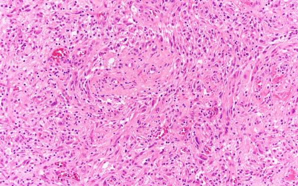 7A2 Gliosarcoma (Case 7) B H&E 20X