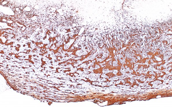 7B1 Gliosarcoma (Case 7) B GFAP 4X