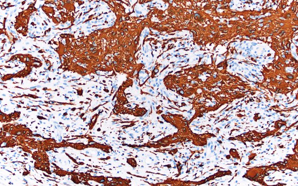 7B2 Gliosarcoma (Case 7) B GFAP 20X