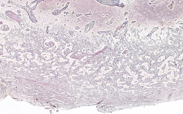 7C1 Gliosarcoma (Case 7) B Retic 4X