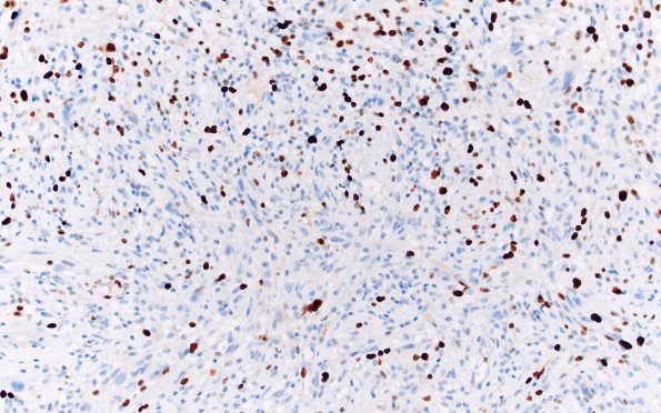 7D2 Gliosarcoma (Case 7) B Ki67 20X