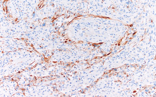 7E2 Gliosarcoma (Case 7) B Desmin 20X