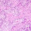  8A Gliosarcoma (Case 8) 1A.jpg