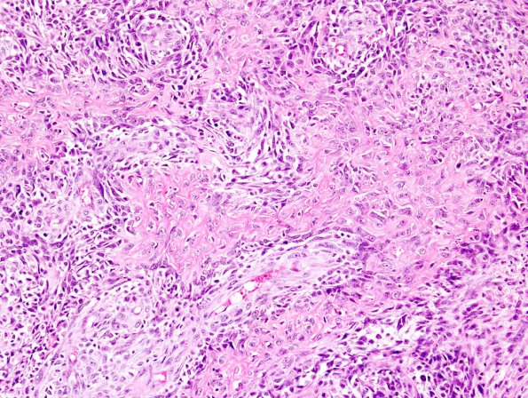  8A Gliosarcoma (Case 8) 1A.jpg