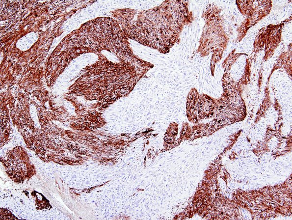  8B1 Gliosarcoma (Case 8) GFAP 1.jpg