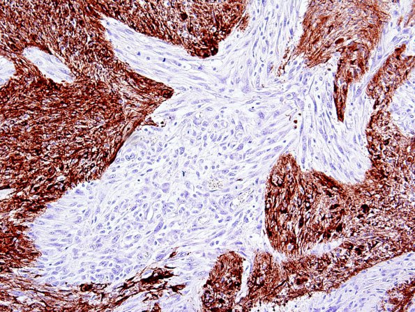  8B2 Gliosarcoma (Case 8) GFAP 2.jpg