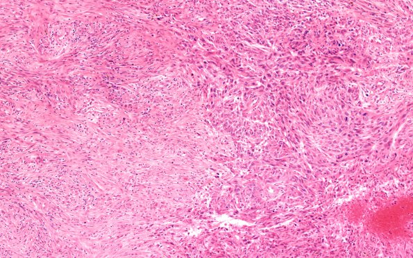 8C1 Gliosarcoma (Case 8) H&E 10X