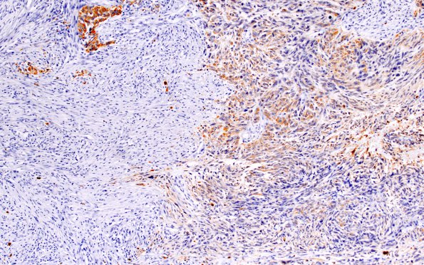 8C2 Gliosarcoma (Case 8) GFAP 10X