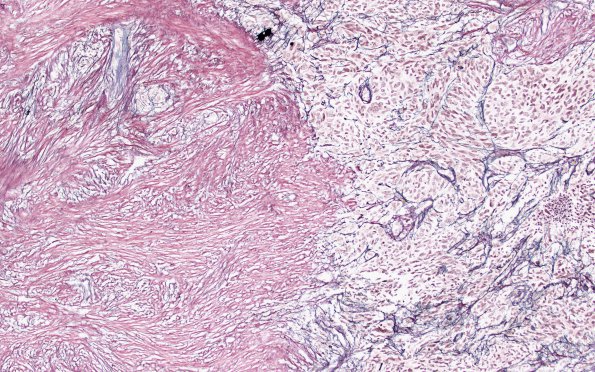 8C3 Gliosarcoma (Case 8) Retic 10X