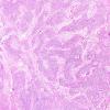 9A2 Gliosarcoma (Case 9) H&E 8