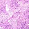 9A3 Gliosarcoma (Case 9) H&E 1