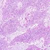 9A4 Gliosarcoma (Case 9) H&E 7