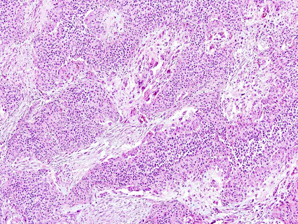 9A4 Gliosarcoma (Case 9) H&E 7