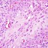 9A5 Gliosarcoma (Case 9) H&E 3