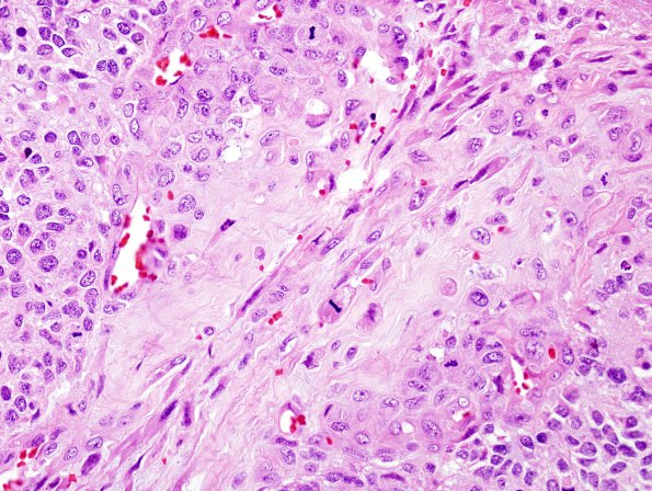 9A5 Gliosarcoma (Case 9) H&E 3