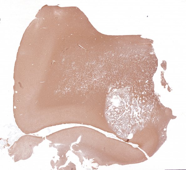 9B1 Gliosarcoma (Case 9) 2 GFAP