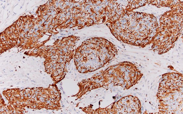 9B3 Gliosarcoma (Case 9) 2 GFAP 20X