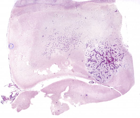 9C1 Gliosarcoma (Case 9) 2 Retic