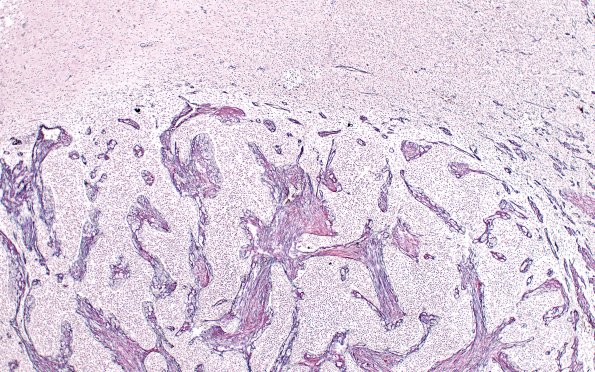 9C2 Gliosarcoma (Case 9) 2 Retic 4X