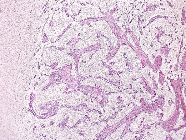 9C3 Gliosarcoma (Case 9) Retic 2