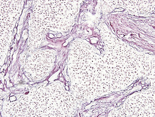 9C4 Gliosarcoma (Case 9) Retic 1