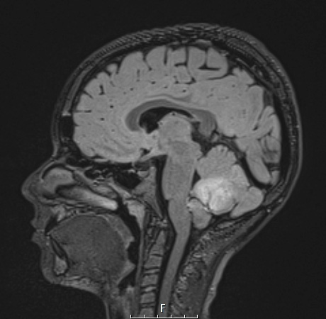 1A1 HGAP (Case 1) FLAIRW - Copy