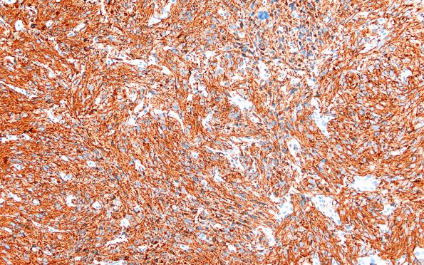 1C1 HGAP (Case 1) GFAP 40X 5A