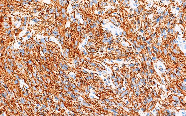 1C2 HGAP (Case 1) GFAP 40X 1