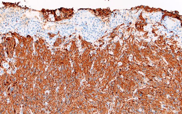 1C3 HGAP (Case 1) GFAP 20X 2