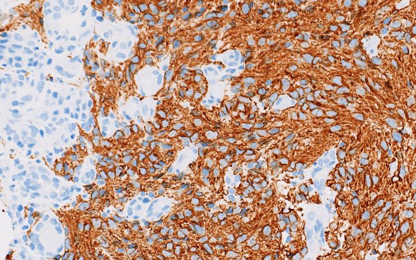 1C4 HGAP (Case 1) GFAP 40X