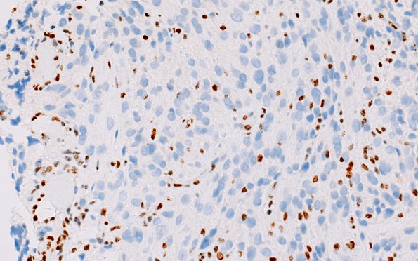 1E2 HGAP (Case 1) ATRX 40X 1