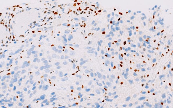 1E3 HGAP (Case 1) ATRX 40X 3