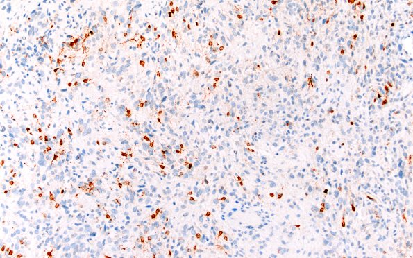 1G1 HGAP (Case 1) P16 20X