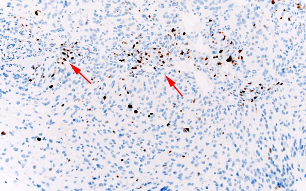 1H1 HGAP (Case 1) Ki67 20X 2 copy