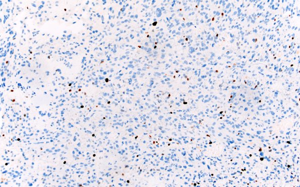 1H2 HGAP (Case 1) Ki67 20X 1