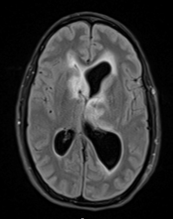 2A1 HGAP (Case 2) FLAIR - Copy