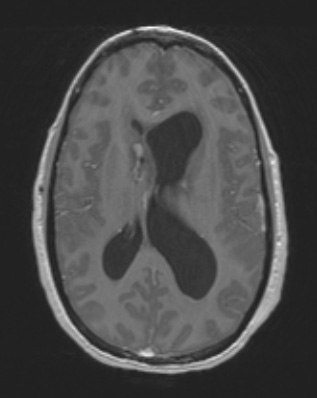 2A2 HGAP (Case 2) T1W - Copy